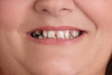 Woman With Crooked Teeth